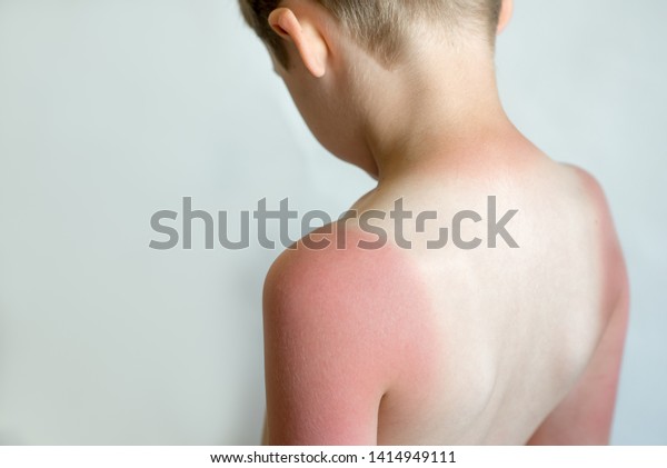 子供の背中の日焼け 少年に強い日焼けが 赤い手と背中 皮膚の痛みが 水ぶくれになった 日差し防止 の写真素材 今すぐ編集