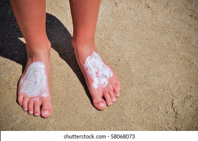 Sunburn On The Feet Of A Boy On The Beach During Their Holidays At Sea