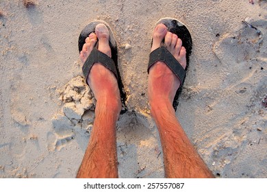 Sunburn On The Feet With Flip Flops, View From Above 
