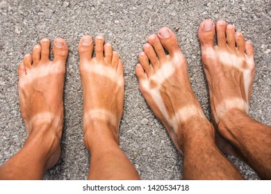 Sunburn On Feet Of Man And Woman. Tanned Skin On Feet With White Stripes.