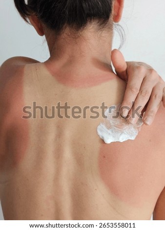 Sunburn relief application on back by individual with skin irritation from sun exposure
