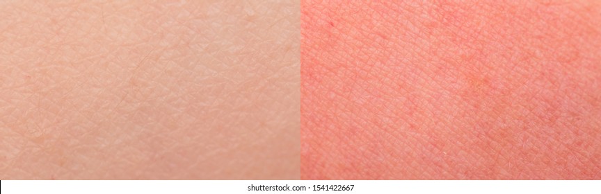 Sunburn skin and normal skin as a texture or background. Selective focus. Extreme macro
