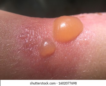 Sunburn Texture In Child Skin