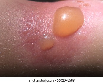 Sunburn texture in child skin