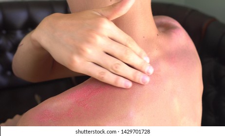 Sunburn Treatment. A Young Man Apply An Antibiotic Sunburn Gel On The Painful, Itchy Sunburns