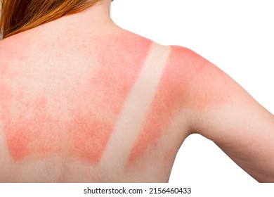Sunburn. Woman got a Sunburn. Red painful skin on back that feels hot to the touch after beach visits. Use Sunscreen or UV protection cream. Summer vacation on ocean beach. White Isolated background.