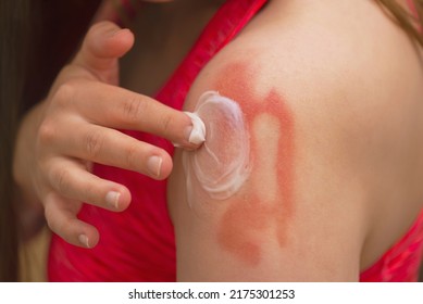  Sunburn,Allergic Reaction, Itching, Allergy, Dermatitis. Close-up Of A Woman Applying Cream Or Ointment To Swollen Skin After A Mosquito Bite, Isolated On A Grey Studio Background.