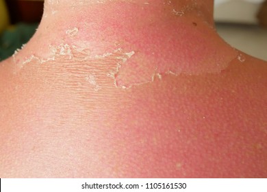 Sunburned Man. Sunburned Heavily, White Skin Versus Very Dark Red And Burned