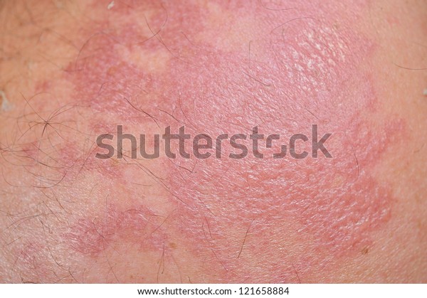 Sunburned Skin Stock Photo (Edit Now) 121658884