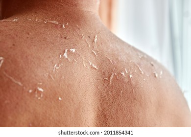 Sunburned Skin Comes Off A Man's Back. Skin Care During Tanning. Sunburn.