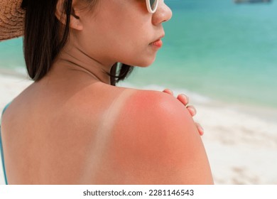 Sunburned skin on shoulder of a woman because of not using cream with sunscreen protection. Red skin sun burn after Sunbathing at the beach. Summer and holiday concept - Shutterstock ID 2281146543