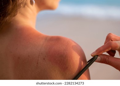 sunburned skin. sunburn skin. sun burn skin. closeup. The concept of sunburn. burnt skin in the sun. close-up. Damaged skins.