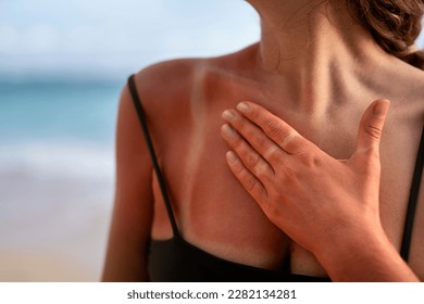 sunburned skin. sunburn skin. sun burn skin. closeup. The concept of sunburn. burnt skin in the sun. close-up. Damaged skins. - Shutterstock ID 2282134281