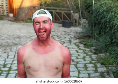 Sunburned young man with extreme tan lines 
