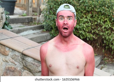 Sunburned Young Man With Extreme Tan Lines 