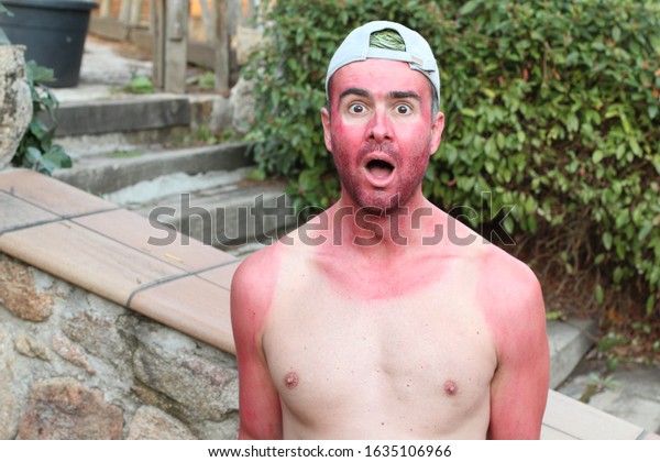 Sunburned young man\
with extreme tan lines\
