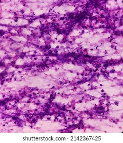 Suppurative lymphadenitis, microscopic view of cervical lymph node fluid show cellular material, polymorphs, lymphocytes and histiocytes.