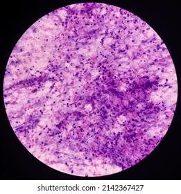 Suppurative lymphadenitis, microscopic view of cervical lymph node fluid show cellular material, polymorphs, lymphocytes and histiocytes.