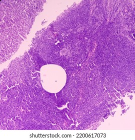 supraclavicular lymph node swollen from mold exposure