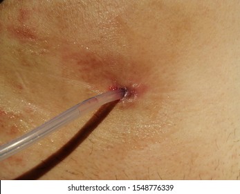 Suprapubic Catheter Inserted In Urinary Retention Patient