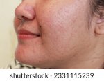 The surface of the facial skin area of ​​the lips and cheeks is slightly reddish and pimples using acne patch