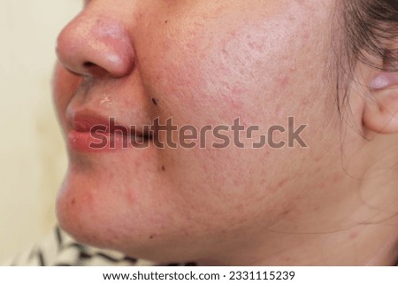 The surface of the facial skin area of ​​the lips and cheeks is slightly reddish and pimples using acne patch
