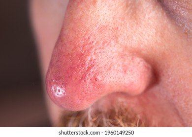 the surface of the skin on the nose in rosacea and eczema