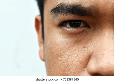 Surface Young Asian Man Face Skin After Not Get A Wink Of Sleep And Do Not Take Care For A Long Time