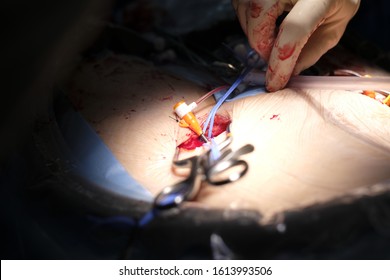 Surgeon Was Accessed 7 Fr Femoral Arterial Sheath To Femoral Artery By Arterial Cutdown Technique