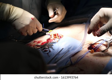 Surgeon Was Accessed 7 Fr Femoral Arterial Sheath To Femoral Artery By Arterial Cutdown Technique