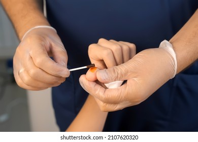 Surgeon is applying iodine on wound after laser removal os wart on thumb, closeup hands. Remove papillomavirus verruca on finger. One day surgery concept. Sore and wound after operation. - Shutterstock ID 2107620320