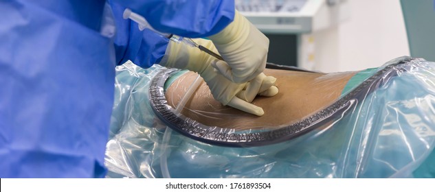 Surgeon In Blue Surgical Gown Uniform Doing Lumbar Puncture Before Insert Epidural Catheter Under Fluoroscope Inside Modern Operating Room. Epidural Steroid Injection Use For Spinal Stenosis Patient.