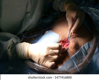 Surgeon Was Cannulated Needle Puncture To Common Femoral Artery By Arterial Cutdown Technique