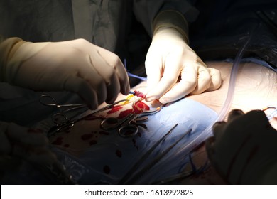 Surgeon Was Cannulated Needle Puncture To Common Femoral Artery By Arterial Cutdown Technique