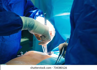 Surgeon Doctor Operating Wearing Special Lamp Lighting Using Clamps For Open Heart Surgery Intervention Close-up, Open Cord Surgery Minimally Invasive Surgery