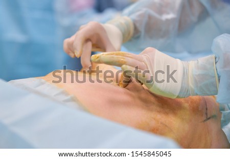 surgeon during liposuction in the operating room