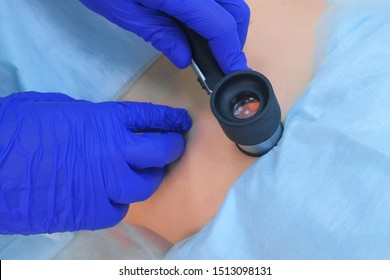 Surgeon examines mole using dermatoscope magnifier before laser removing on patient woman back in clinic, hands in gloves closeup. Cancer risk prediction concept. One day surgery cosmetic treatment.