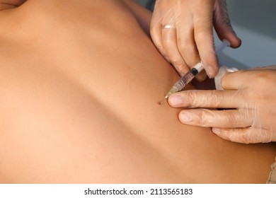 Surgeon gives injection of local anesthesia during laser removing mole on back, closeup view. One day surgery concept. Spine of teen boy patient in hospital with moles, warts. - Shutterstock ID 2113565183