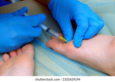 Surgeon in gloves is making injection of local anesthesia on boy's foot before laser removing of wart. Remove papillomavirus verruca on leg. One day surgery concept. Sore and wound before operation. - Shutterstock ID 2102429194