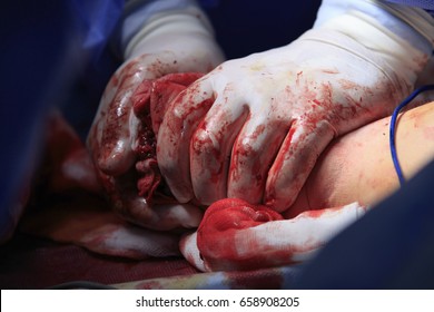 Surgeon hands in bloodstained gloves presses the stump after amputation to stop bleeding close up