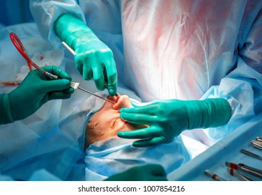 Surgeon and his assistant performing cosmetic surgery on nose in hospital operating room. Nose reshaping, augmentation. Rhinoplasty. - Shutterstock ID 1007854216