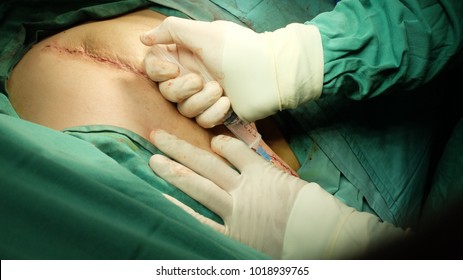 Surgeon Injecting Local Anesthesia Around The Post Operative Wound.