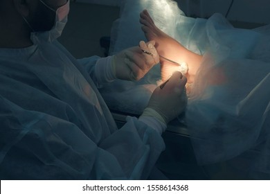 Surgeon Man Making Surgery Of Removal Ankle Hygroma In Hospital In Operating Room. Doctor Presses Cotton Swab To Patient Ankle With Clamp. Operation Surgical Treatment Of Hygroma On Leg.