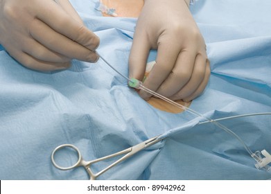 Surgeon Manipulating A Flexible Catheter Into Patient During Surgery