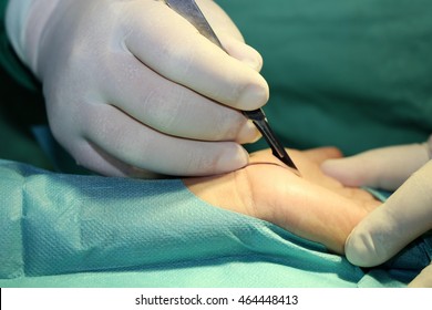 A surgeon operates carpal tunnel syndrome