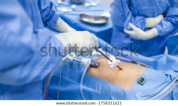 Surgeon perform laparoscopic cholecystectomy in\
gall stone patient with abdominal pain.Doctor and scrub nurse in\
blue surgical gown suit doing keyhole surgery inside operating\
room.Medical concept.