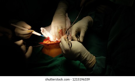 Surgeon performing Mastectomy surgery in patient with Breast Carcinoma.
