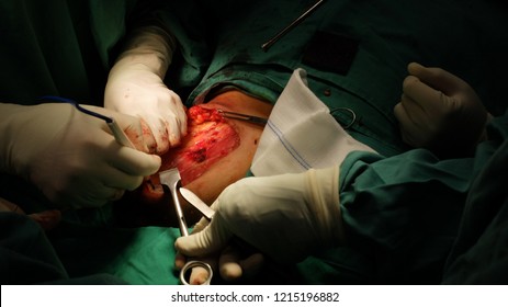Surgeon performing Mastectomy surgery in patient with Breast Carcinoma.