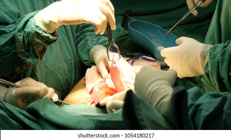 Colectomy surgery