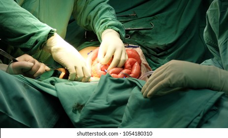Surgery colectomy Partial Colectomy